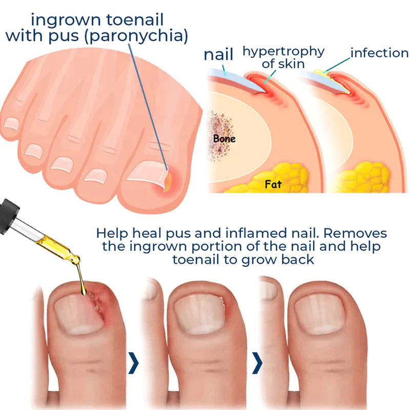 NailPlus™ Anti Paronychia Olie